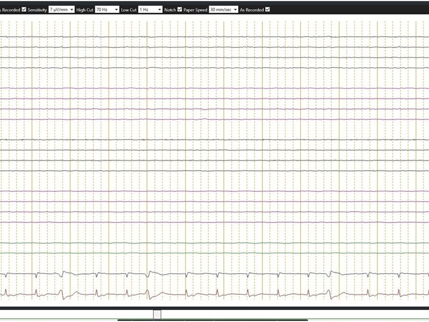 Frontiers Ancillary Tests For Brain Death